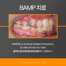 잠원동 61-6 _ | 잠원동 교정치과 아래턱이 나온 3급 부정교합