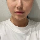 다산 피부과 울쎄라 200샷 솔직 후기