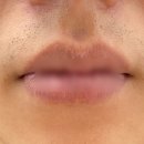 서울메디의원 | 서울 중구 해피메디의원 제모 듀에또 내돈내산 후기[1]