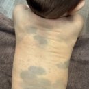 선천성 이소성 몽고반점 등 엉덩이 레이저치료 현대해상 보험청구 후기