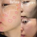 파리바게뜨 논현1단지점 | 강남논현피부과 기미잡티 점제거 레이저 일주일 솔직 후기 딱지생김 점빼기 관리꿀팁 비용