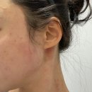 당당한의원 | 강남역 편평사마귀제거 잘하는 한의원 내돈내산 2주차 후기