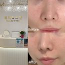 러블리스킨&바디 | 계산동 에스테틱 추천 | 뷰티앤스킨 5년째 내돈내산 여드름관리 받는 이유