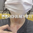 잇츠멍 | 알레르기 인간의 편평사마귀 얼굴, 목 제거후기 (고덕잇츠미의원) _ 마취크림 알레르기, 듀오덤...