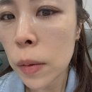 쥬베룩 볼륨 후기, 안아픈 블룸쥬베룩 효과~!!!