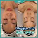 의정부에스테틱 루비나 PHA물톡스 관리 후기!