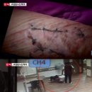 [단독] 요양원에서 팔순 치매노인 폭행.."팔 찢어지고 멍들고.." 이미지