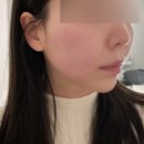 오푸스 | 청담동피부과 오푸스 레이저 리프팅 후기 (키닥터, 효과, 다운타임, 추천VS비추천)