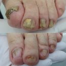 세븐일레븐 원주A도로점 | <원주 문제성발> 먼저 관리 받고 가신 아드님이 모시고 온 85세 어머님 발톱무좀스케일링 후기