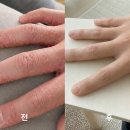 손가락사이습진 증상 가려움 약국연고 보습크림 관리 후기