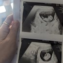 멍Mother | 임신 막달, 이제서야 써보는 임신 기록(미국-한국 산부인과)