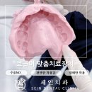 코골이수술없이 치과장치로 코골이치료 가능합니다