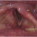 갑상선암 수술 합병증으로 발생하는 성대마비 이미지