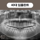 발안치과 온리원 40대 임플란트 시술과정 후기