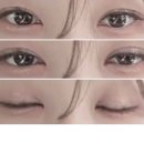 쌍수인 | 쌍수 재수술 후기 4탄 | 완전절개 + 눈매교정