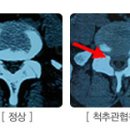 * 척추관 협착증과 요추 디스크 이미지