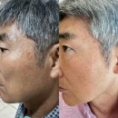 *별내* 남양주기미색소치료잘하는곳 / 별내 기미색소치료 3차후기