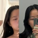 선메디라인의원 | 강남에서 유명한 리프팅 강남역 온다리프팅 2회차 후기