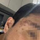 명한의원 | 수원 인계동 여드름흉터 새살침 한의원 1회차 솔직 후기