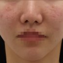 편하지의원 | 신사역 중안부 실리프팅 후기? 광고 피하는 2가지 방법