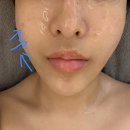 필 | 광주상무지구 <수얀스킨케어> 트로이필 리얼후기