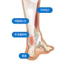 아킬레스건 통증 원인 및 과 : 파열 염증(아킬레스건염) 이미지