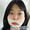 피자써클안면점 | #핀제거후기D+10) 실밥 너란.. 녀석... (ex.17:1로 싸운 얼굴 근황)