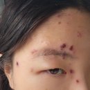 으랏차정형외과의원 | 한쪽 관자놀이가 아파요=삼차신경통X 대상포진O, 평택 대상포진 입원 으랏차정형외과 후기