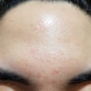 수월한의원 | 여드름흉터한의원 흉터치료 받았던 내 솔직 후기