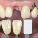 크리스탈치과기공소 네이버블로그