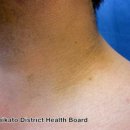 가시 살이 이미지