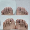 레푸스 | 문제성발톱 스케일링 레푸스 청계천점 후기