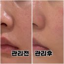 광주118 | [경기 광주] 엘덤에스테틱 :: 태전동 모공 수분 홍조 문제성 피부관리 후기