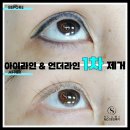 언더라인문신제거,오래된 언더문신제거 후기/ 탁월한 솜씨 강남수아미!!