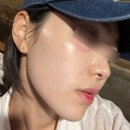 장산한의원 | 부산 장산역피부과 ASCE엑소좀 팔자주름 관리 후기 효과, 통증 내돈내산