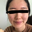 열린화장품 | 청소년 여드름 화장품 폼클렌징 추천