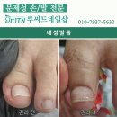 문제성 손발전문샵에서 내성발톱 무좀 발각질 관리해야하는 이유! #루씨드네일샵 #전라도 이미지