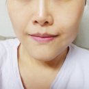 골드신㈜ | (팔자주름리프팅)' 웰로 리프텐' 사용 4주 리얼후기예요