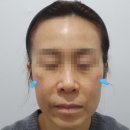 GPT 토닝 후기 지속된 난치성 색소 병변을 옅게 만든 사례