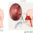 코가 부었어요 코부음 원인 코 관리법 이미지