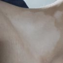 올리브피부과의원 | 판교 직장인 피부과 추천｜엑시머레이저·표피이식 백반증 치료 후기 메이저피부과의원 분당점