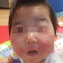 태열, 아토피, 스테로이드 부작용 회복이야기