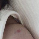 예담소아청소년과병원 | 세종충남대병원 소아청소년과 예방접종 후기｜BCG 피내·RSV·2개월 접종