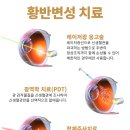 시력에 치명적인 황반변성(AMD) 치료법 알아보기