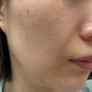인더마화수분 | 인퓨스킨 솔직 후기 💉하이브리드 HA 스킨부스터 체험기