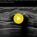 유방-석회화 동반 섬유 선종(calcified fibroadenoma) 이미지