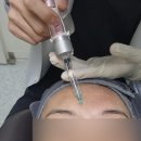 바비박스&개념떡볶이 | 홍대 | 안 아픈 리쥬란힐러+리쥬란아이 얼굴전체 통증 효과 후기