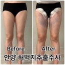 시대병원 | 안양범계 허벅지지방추출주사 완전 상세한 당일 후기