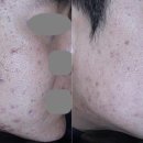 이마 여드름 흉터 &#39;한 번에 해결?&#39; 광고에 속지 마세요 (피부과 전문의 작성)