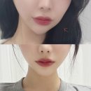 더왈츠의원 | [더왈츠의원] 강남역 피부과, 비대칭 교정 내돈내산 실리프팅 후기